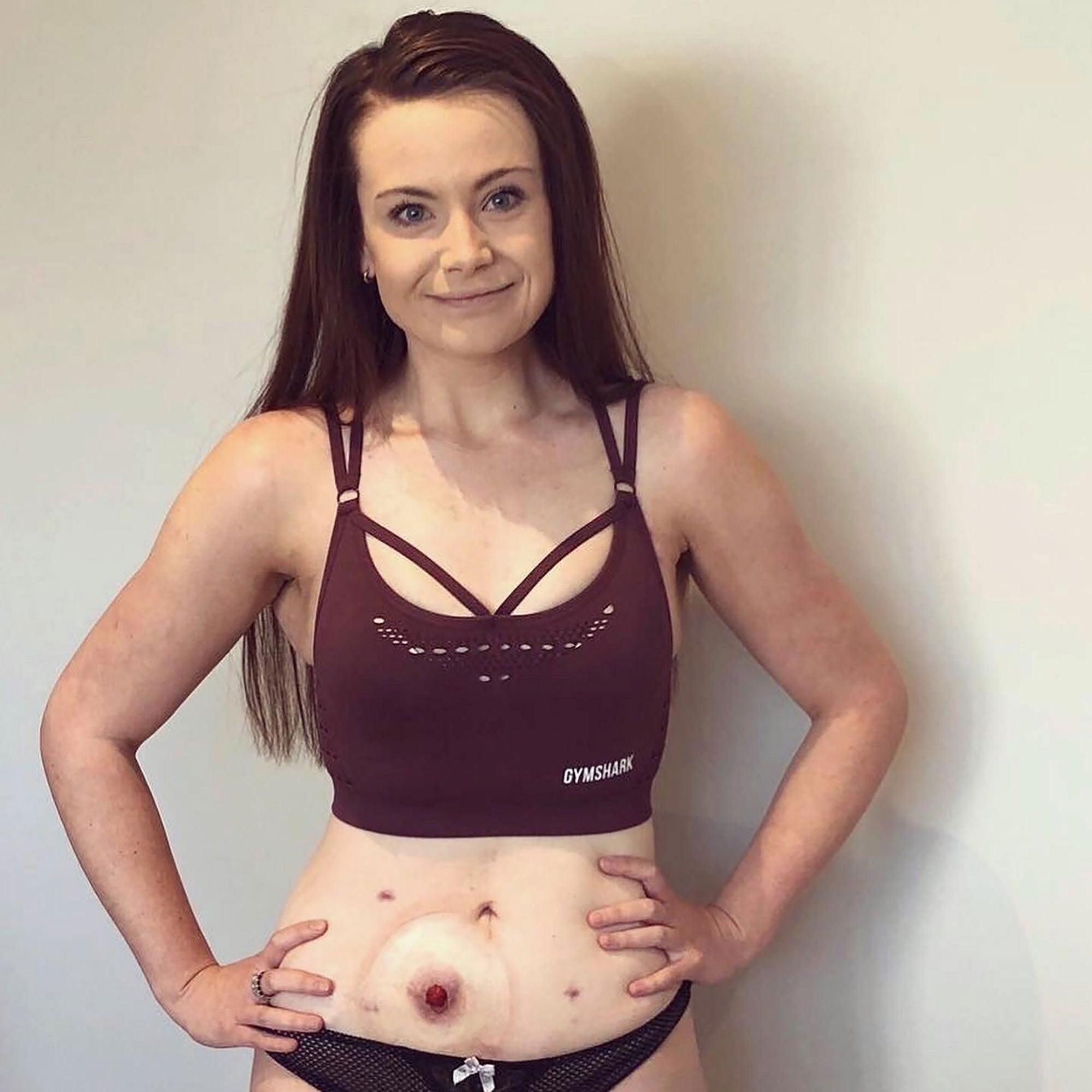 My Stoma Saved Me But Damaged My Mental Health