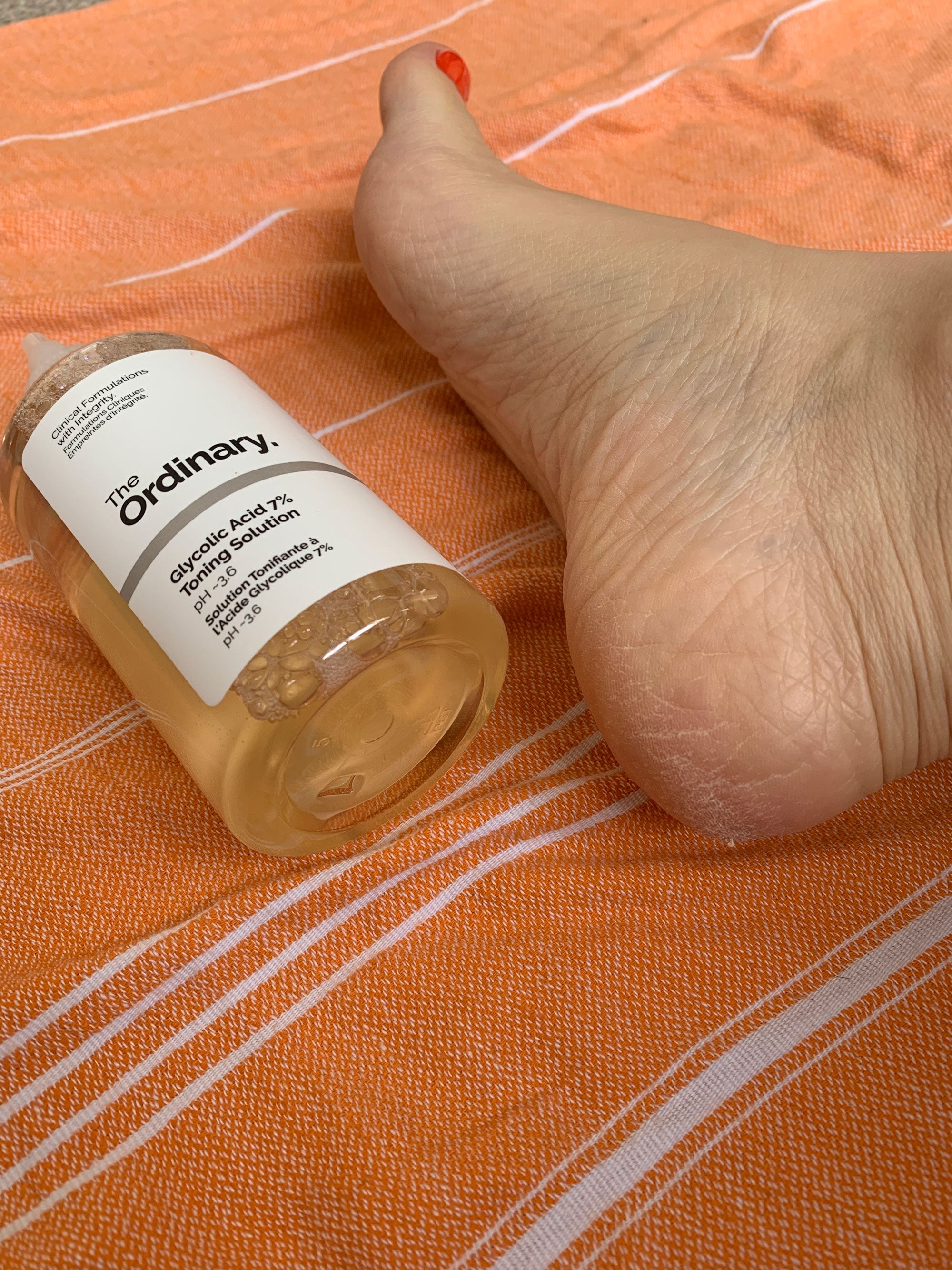 How to heal cracked heels - Mayo Clinic News Network