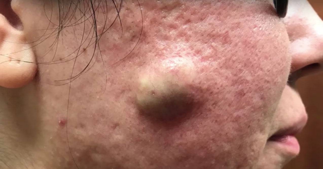 Best Dr Pimple Popper Cyst Videos All Fans Must Watch   9349630 