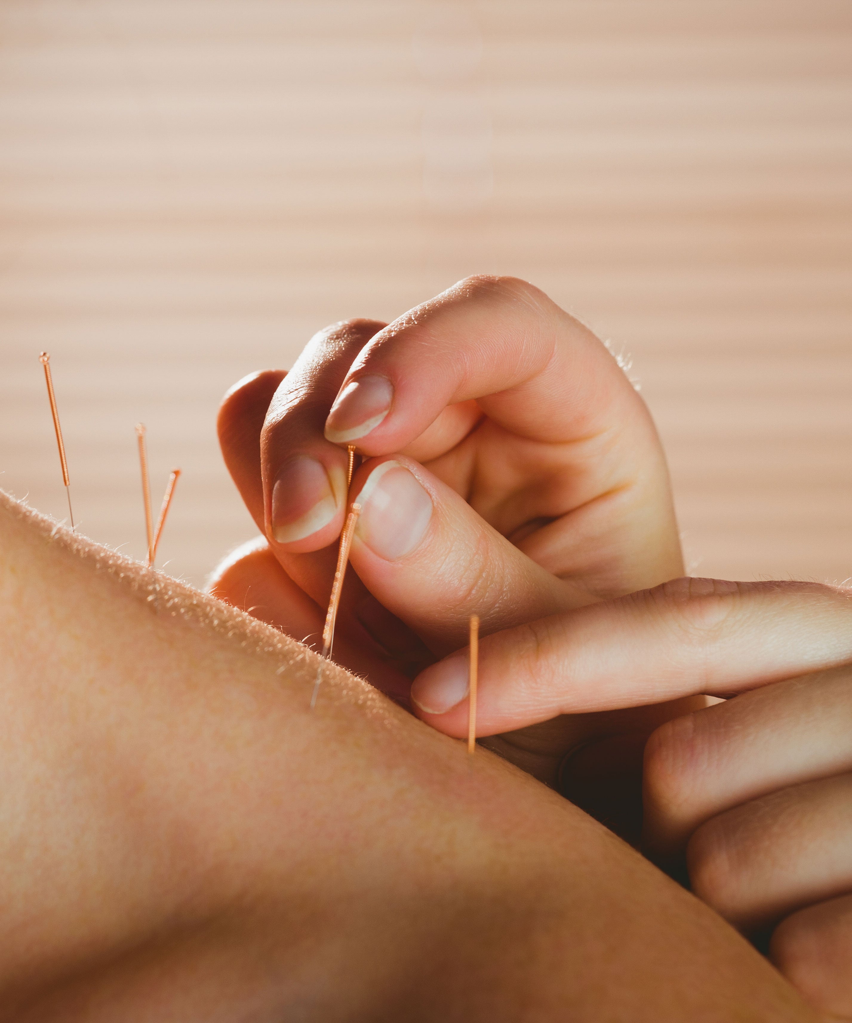 Acupuncture for endometriosis: Can it help & how to do it safely